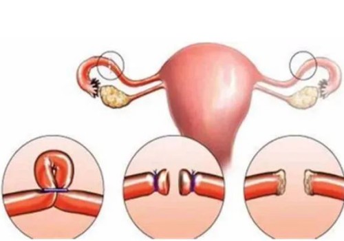 寧波供卵試管：子宮腺肌癥可以通過中醫(yī)治療，這些緩解子宮腺肌癥方法也不要忽略