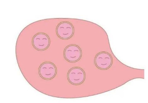 寧波試管嬰兒價(jià)格：怎樣解決子宮肌瘤帶來的困擾？