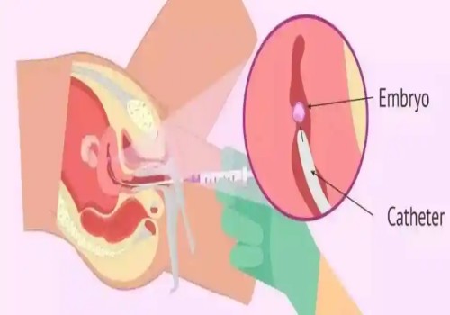 偶發(fā)還是遺傳？看看4號(hào)染色體三體異?，F(xiàn)象的真正原因