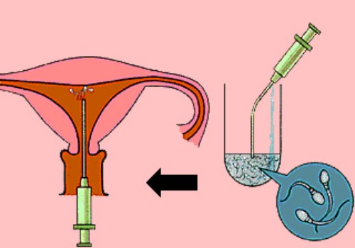 盤(pán)點(diǎn)試管嬰兒希愛(ài)力的正確使用方法，注意時(shí)間和劑量才是關(guān)鍵